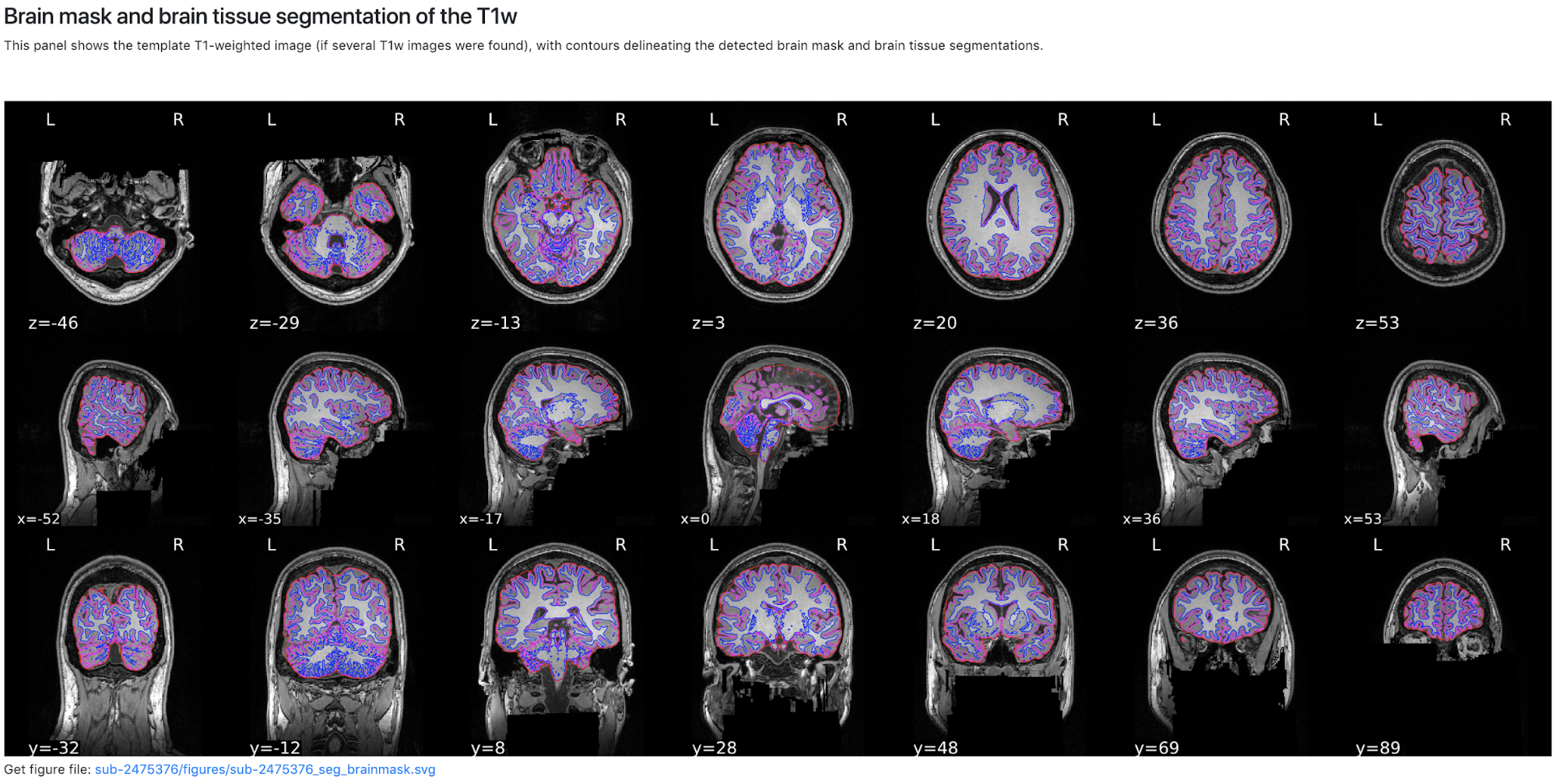 Brain_mask_and_brain_tissue_segmentation_of_the_T1w